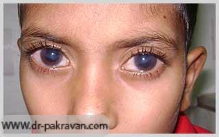 برخی علایم کودکان مبتلا مانند لک سفید قرنیه ممکن است علی‌رغم درمان کاملا از بین نروند.